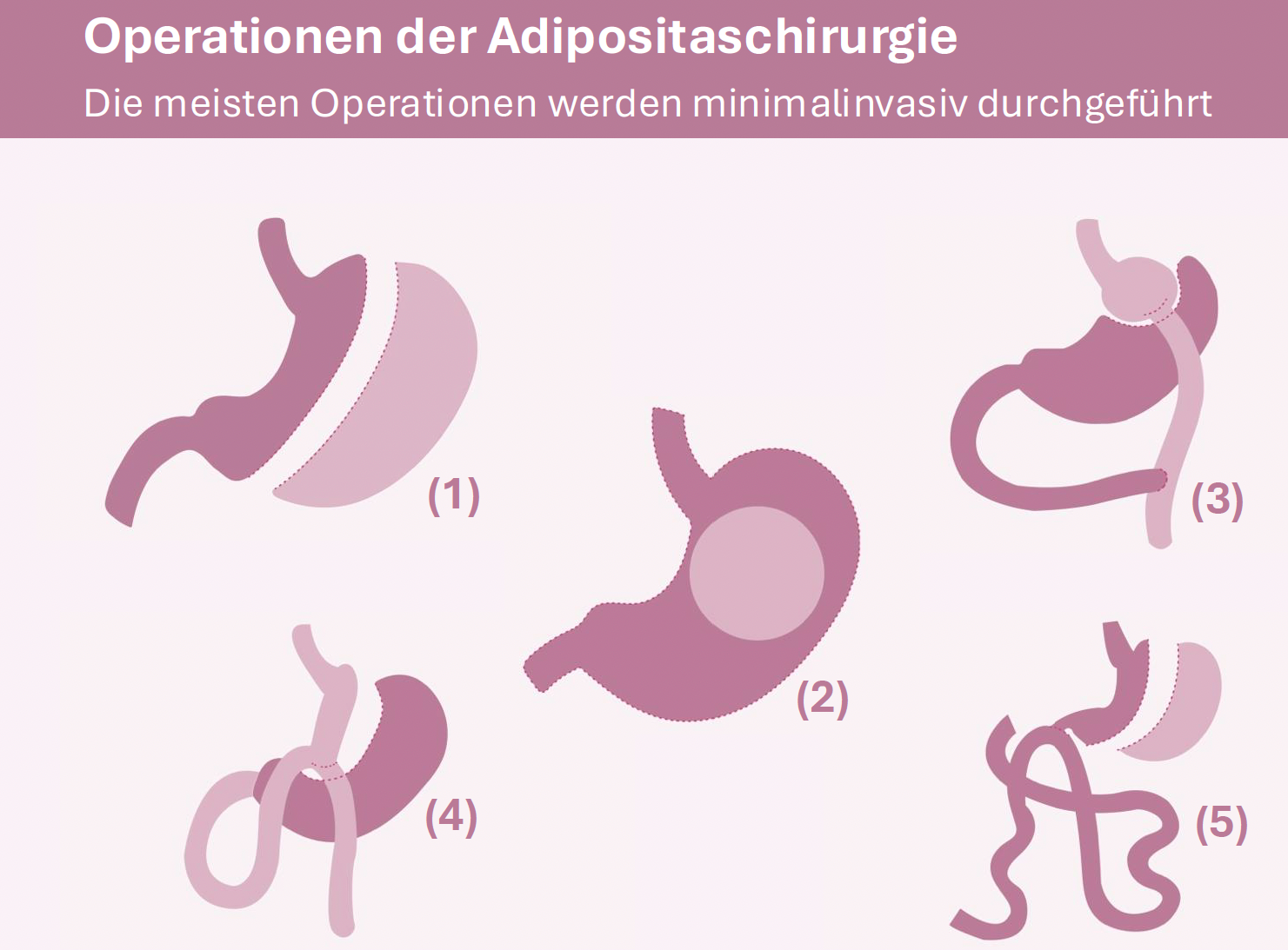 Abbildung: (1) Magenschlauch (Sleeve), (2) Magen-Ballon, (3) Magenbypass, (4) Omega- Bypass, (5) SADI Abbildung: (1) Magenschlauch (Sleeve), (2) Magen-Ballon, (3) Magenbypass, (4) Omega- Bypass, (5) SADI